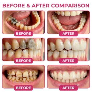🇺🇸Trilumia® DenPerm🦷 Cavity-Repair Natural Enamel Filling Gel🥗
 – waletuo