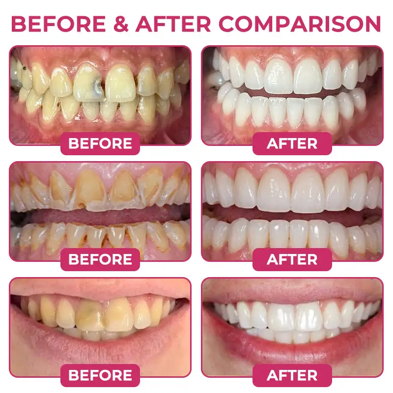 🇺🇸Trilumia® DenPerm🦷 Cavity-Repair Natural Enamel Filling Gel🥗
– waletuo