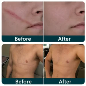 🇺🇸👩‍⚕️✨Trilumia® Silicone Scar Therapy Roll — Custom-Fit Care for Long, Raised Surgical Scars
