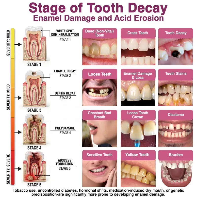 👨⚕️ Official Store ✨ Trilumia® DenPerm 🦷 Cavity-Repair Natural Enamel
– Petal Twist